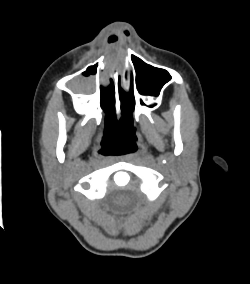 Nasoorbitoethmoid fracture (Radiopaedia 90044-107205 Axial non-contrast 112).jpg