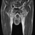 Necrotizing epididymo-orchitis with intra-testicular abscess (Radiopaedia 29397-29860 Coronal T1 C+ 8).jpg