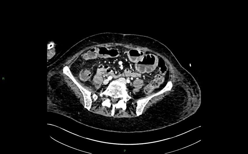 Neo-terminal ileal stricture (Crohn disease) (Radiopaedia 33790-34948 A 310).jpg