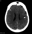 Neurocysticercosis (Radiopaedia 7773-8596 C+ delayed 11).jpg