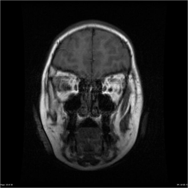 File:Neurofibromatosis type 1 (Radiopaedia 22541-22564 Coronal T1 19).jpg
