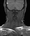 Neurofibromatosis type 1 (Radiopaedia 80355-93740 Coronal T1 14).jpg