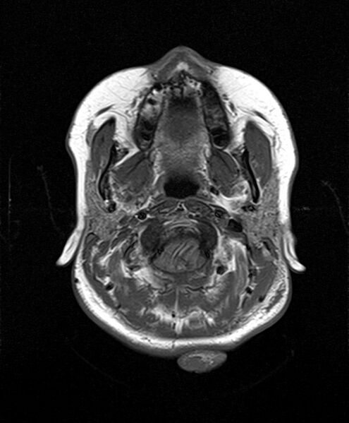File:Neurofibromatosis type 2 (Radiopaedia 66211-75401 Axial T1 6).jpg