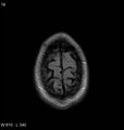 Neurosarcoidosis (Radiopaedia 10930-11351 Axial FLAIR 19).jpg