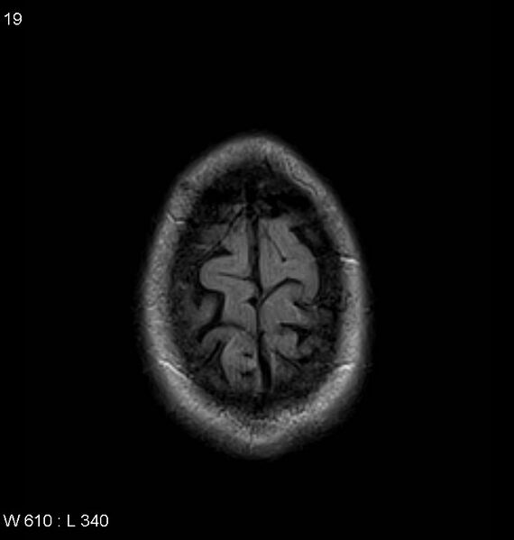 File:Neurosarcoidosis (Radiopaedia 10930-11351 Axial FLAIR 19).jpg