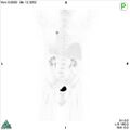 Non-Hodgkin lymphoma involving seminal vesicles with development of interstitial pneumonitis during Rituximab therapy (Radiopaedia 32703-33752 PET cor 3D MIP 7).jpg