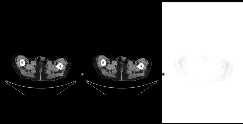 File:Non-Hodgkin lymphoma involving seminal vesicles with development of interstitial pneumonitis during Rituximab therapy (Radiopaedia 32703-33761 ax CT Fus PET 63).jpg