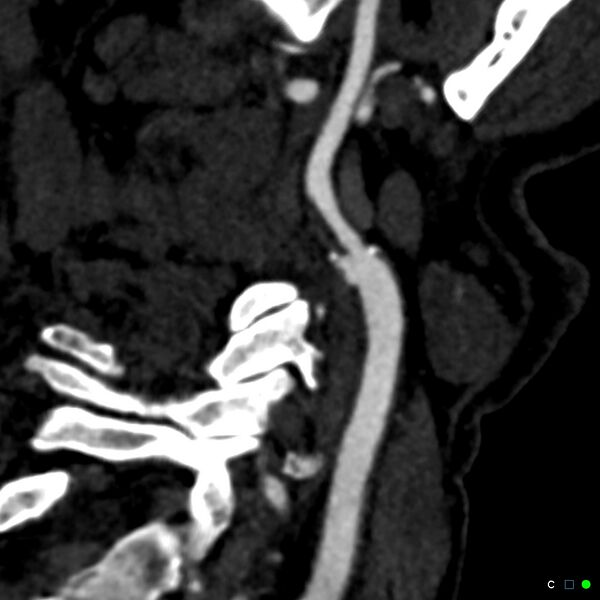 File:Non-occlusive intraluminal internal carotid artery thrombus (Radiopaedia 37751-39658 C 13).jpg
