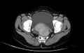 Non-puerperal uterine inversion (Radiopaedia 78343-91094 A 54).jpg