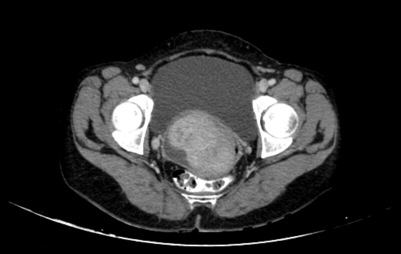 File:Non-puerperal uterine inversion (Radiopaedia 78343-91094 A 54).jpg