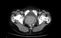Non-puerperal uterine inversion (Radiopaedia 78343-91094 A 76).jpg
