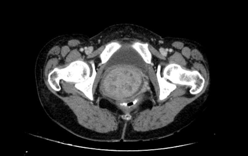 File:Non-puerperal uterine inversion (Radiopaedia 78343-91094 A 76).jpg