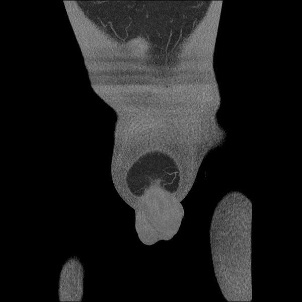 File:Normal CT angiogram of pelvis (Radiopaedia 45390-49430 B 8).jpg