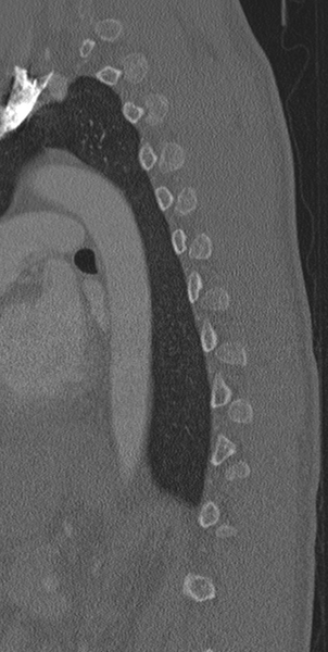 File:Normal CT thoracic spine (Radiopaedia 40181-42688 Sagittal bone window 17).png