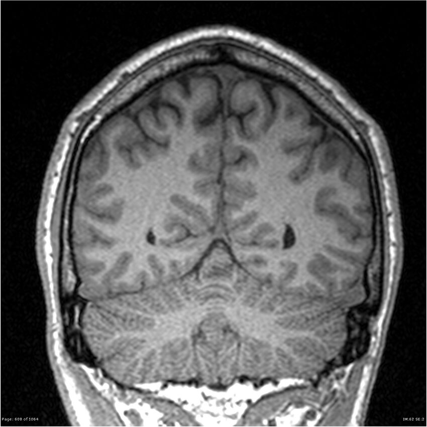 Normal brain MRI (non-focal epilepsy protocol) (Radiopaedia 38571-40700 Coronal T1 30).jpg