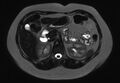 Normal liver MRI with Gadolinium (Radiopaedia 58913-66163 E 16).jpg