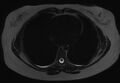 Normal liver MRI with Gadolinium (Radiopaedia 58913-66163 E 34).jpg
