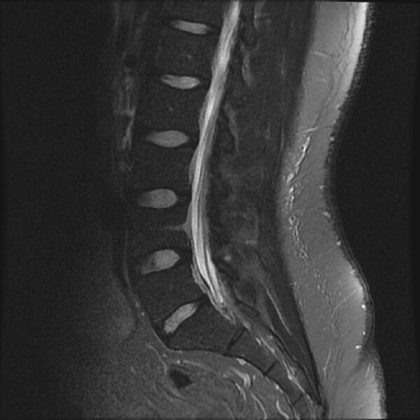 File:Normal lumbar spine MRI (Radiopaedia 43051-46311 Sagittal STIR 12).jpg