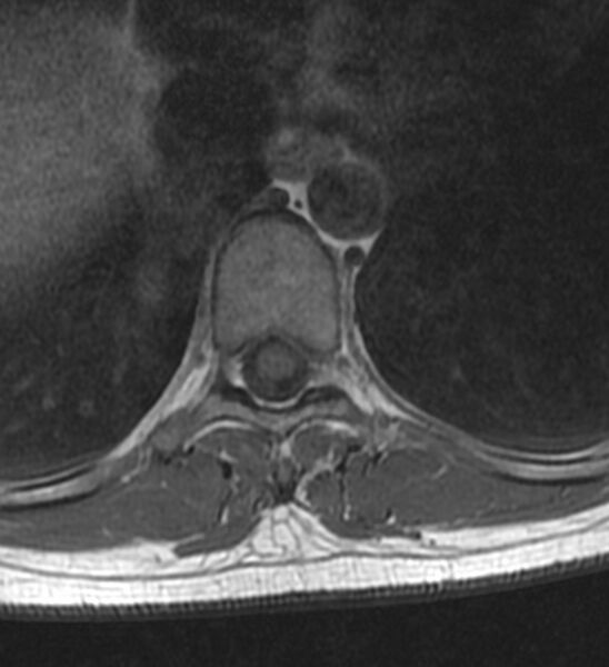 File:Normal thoracic spine MRI (Radiopaedia 41033-43781 Axial T1 11).jpg