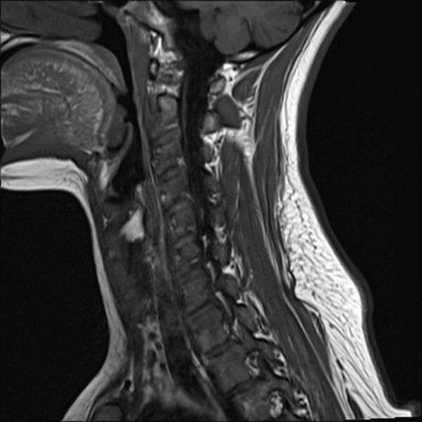 File:Normal trauma cervical spine MRI (Radiopaedia 32130-33071 Sagittal T1 5).jpg