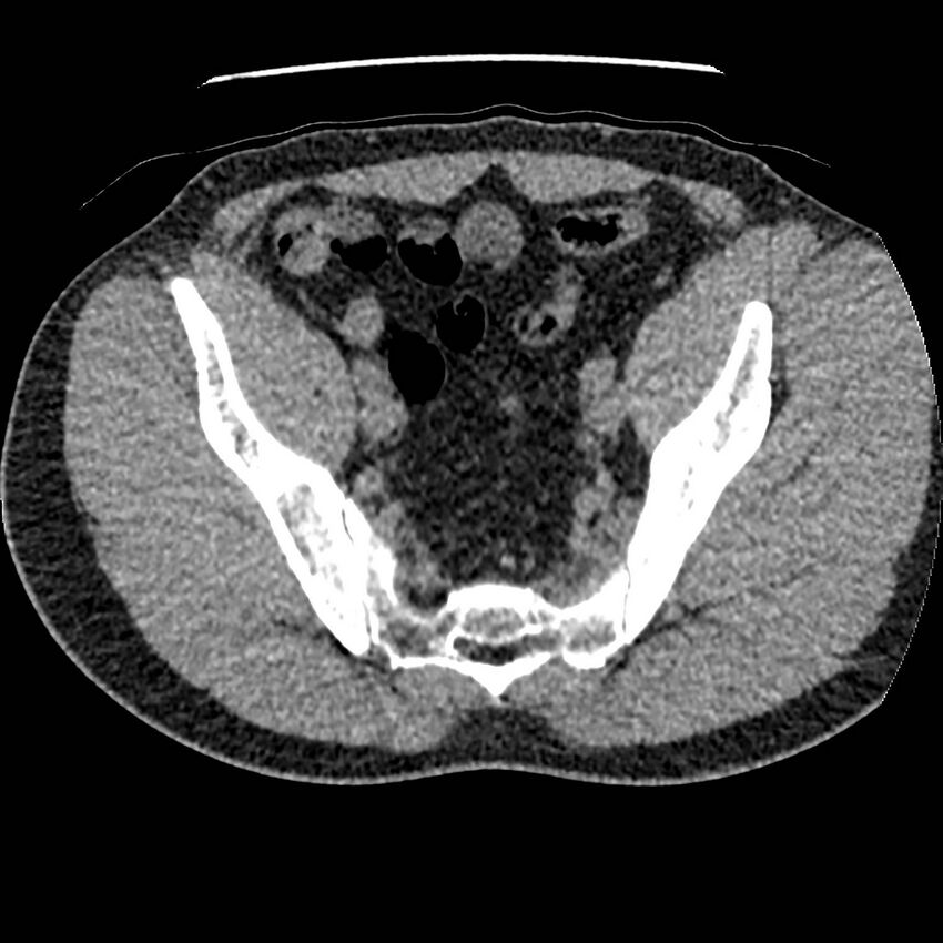 Obstructing ureteric calculus and ureteric anatomy (Radiopaedia 62730-71042 Axial non-contrast 134).jpg