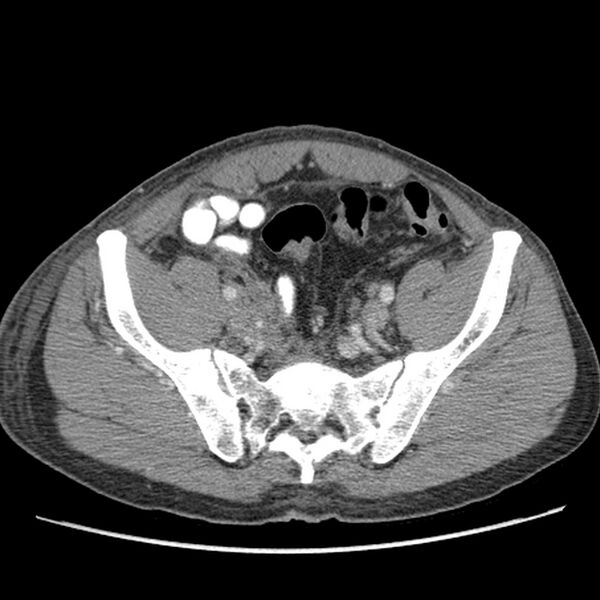 File:Obstructive bladder transitional cell carcinoma (Radiopaedia 9825-10410 A 24).jpg