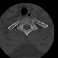 Occipital condyle fracture (Radiopaedia 31755-32691 Axial bone window 75).jpg