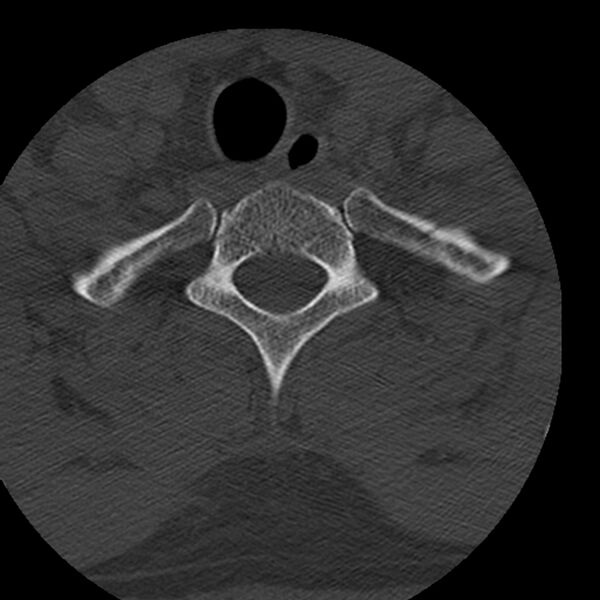 File:Occipital condyle fracture (Radiopaedia 31755-32691 Axial bone window 76).jpg