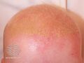 Seborrhoeic dermatitis (DermNet NZ dermatitis-cradle).jpg