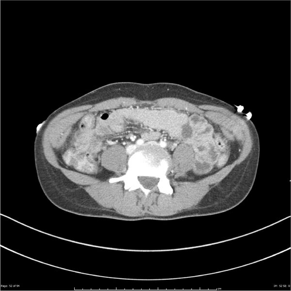 File:Traumatic renal artery dissection and pancreatic transection (Radiopaedia 37061-38739 Axial 214).jpg