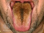 (DermNet NZ site-age-specific-s-black-hairy-tongue-2).jpg