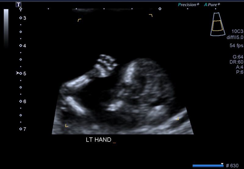 File:1st trimester nuchal-morphology ultrasound (Radiopaedia 44706-48477 General anatomy and NT 34).jpg