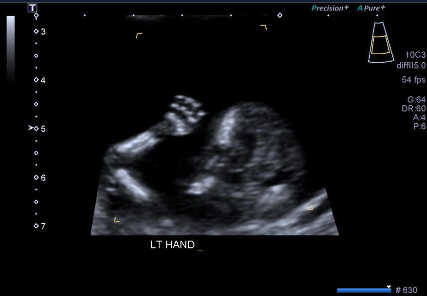 1st trimester nuchal-morphology ultrasound (Radiopaedia 44706-48477 General anatomy and NT 34).jpg