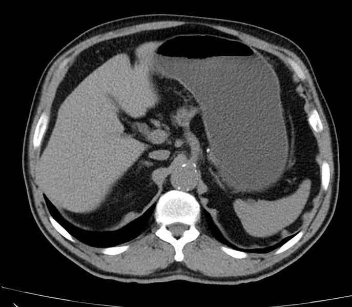 File:Abdominal aortic aneurysm (Radiopaedia 22421-22458 non-contrast 13).jpg