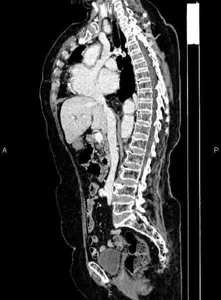 File:Abdominal aortic aneurysm (Radiopaedia 85063-100606 Sagittal C+ arterial phase 37).jpg
