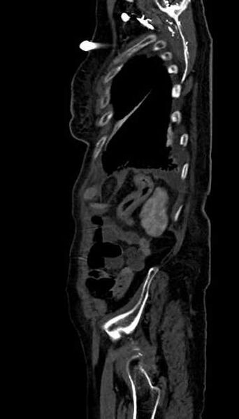File:Abdominal aortic aneurysm with thrombus fissuration (Radiopaedia 73192-83919 Sagittal C+ arterial phase 12).jpg