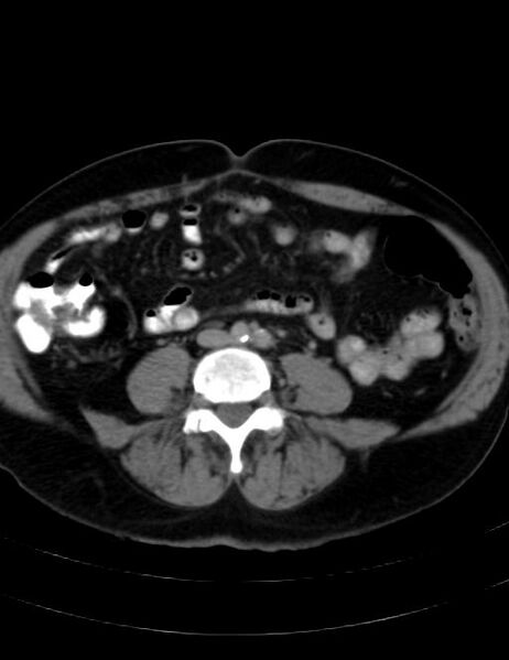 File:Abdominal lymphoma - with sandwich sign (Radiopaedia 53486-59492 Axial C+ portal venous phase 31).jpg
