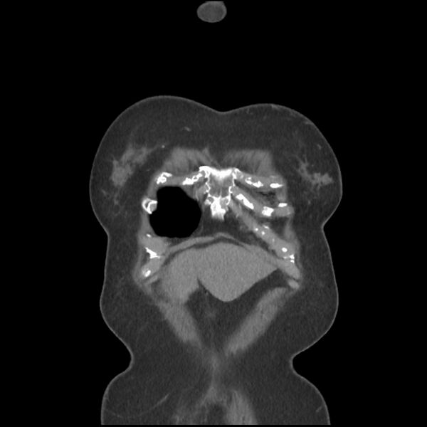 File:Aberrant right subclavian and left vertebral arteries (Radiopaedia 43467-46847 Coronal C+ portal venous phase 7).jpg