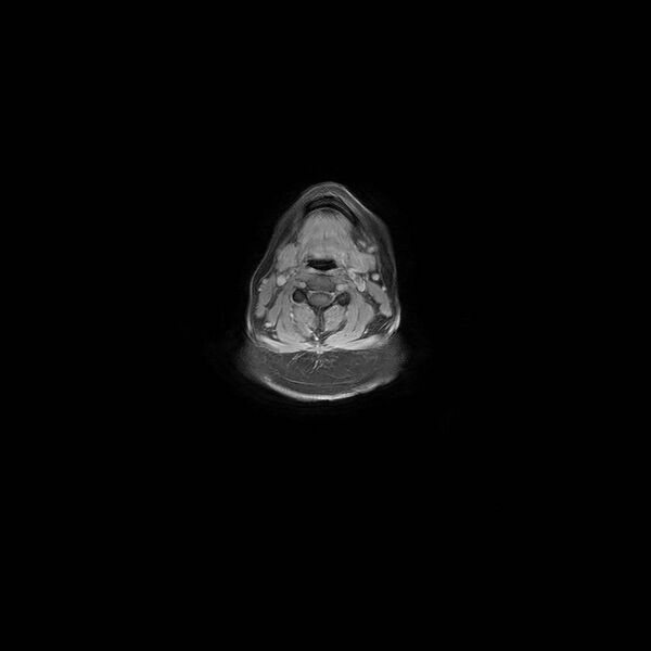File:Aberrant right subclavian artery with background Takayasu arteritis (Radiopaedia 21423-21363 Axial MRA 59).jpg