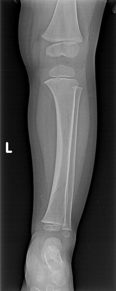 File:Accidental or innocent toddler fracture (Radiopaedia 49764-55024 Frontal 1).jpg