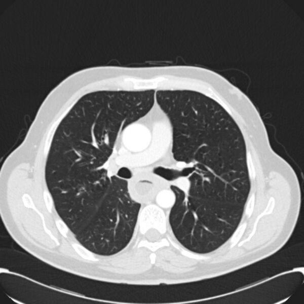 File:Achalasia (Radiopaedia 24937-25206 Axial lung window 15).jpg