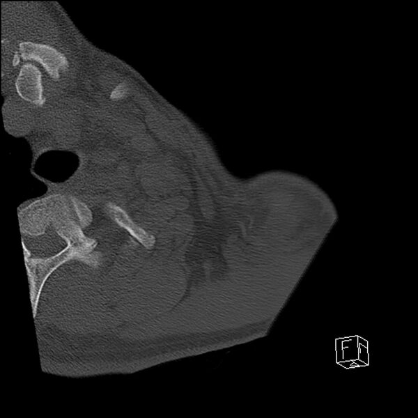 File:Acromioclavicular joint dissociation - type IV (Radiopaedia 64411-73216 Axial bone window 2).jpg