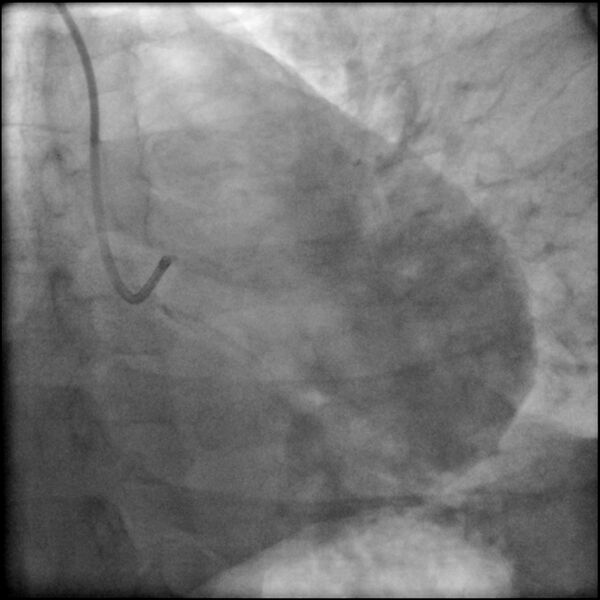 File:Acute anteroseptal myocardial infarction (Radiopaedia 68409-77946 LAO caudal (spider view) LAD and CX 2).jpg