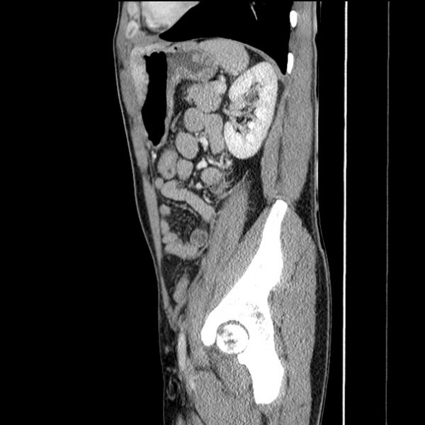 File:Acute appendicitis (Radiopaedia 27049-27227 Sagittal C+ portal venous phase 58).jpg