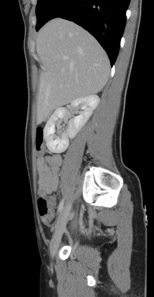 File:Acute appendicitis (Radiopaedia 62608-70901 Sagittal C+ portal venous phase 41).jpg