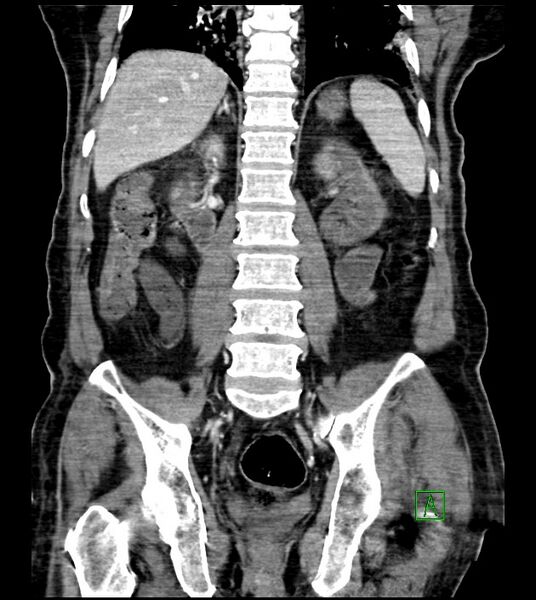 File:Acute arterial mesenteric ischemia (Radiopaedia 78238-90828 Coronal C+ portal venous phase 62).jpg