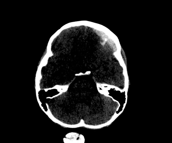 File:Acute epidural hematoma (Radiopaedia 63659-72335 Axial subdural window 7).jpg