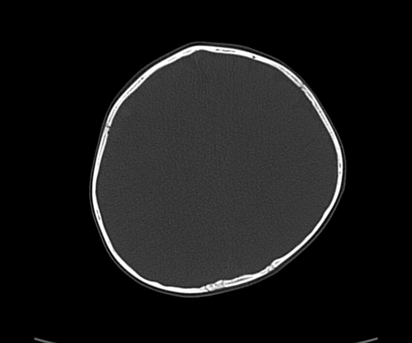 Acute hemorrhagic contusion (Radiopaedia 63660-72336 Axial bone window 46).jpg