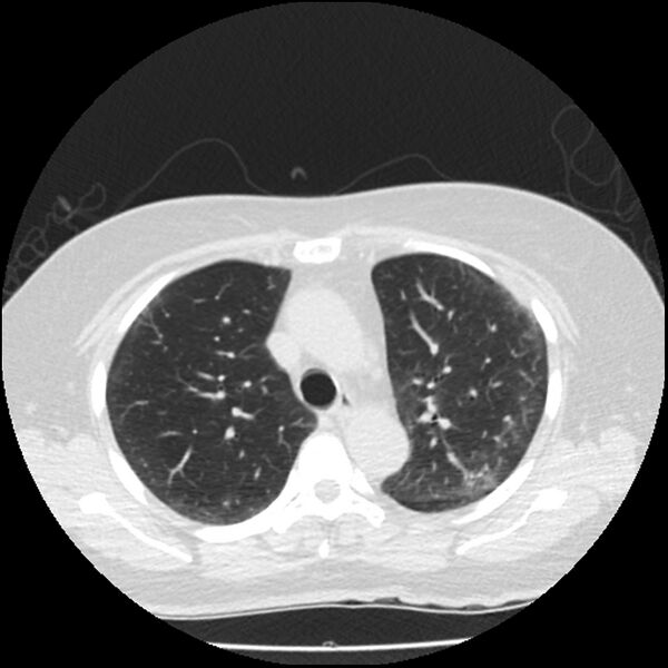 File:Acute interstitial pneumonitis (Radiopaedia 45404-49444 Axial lung window 35).jpg