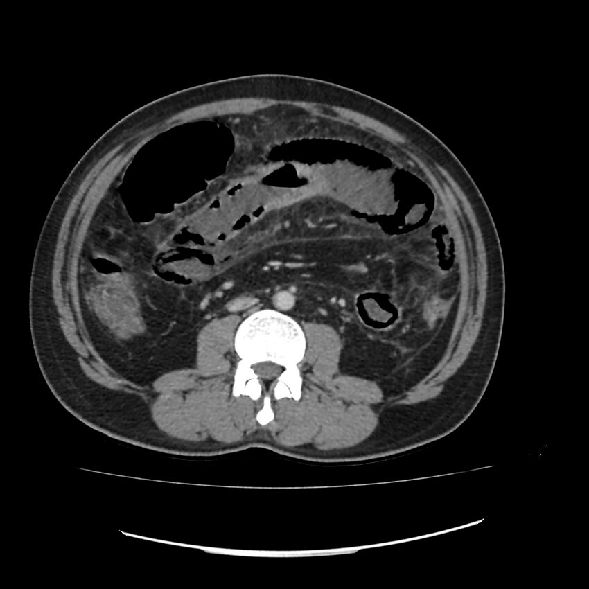 Acute mesenteric ischemia - superior mesenteric artery thrombosis (Radiopaedia 73947-84776 Axial C+ portal venous phase 73).jpg